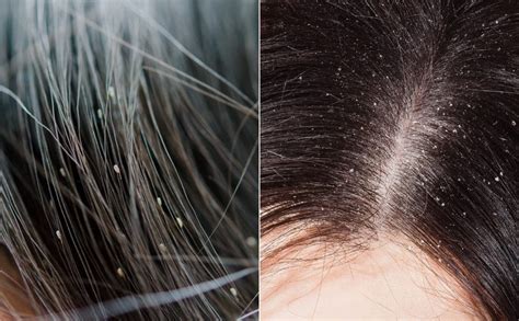 Lice Vs Dandruff Differencescausessymptoms And Solutions