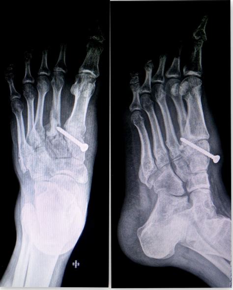 Excessive pf and abduction forces. Divergent Lisfranc injury with dislocation of great toe ...