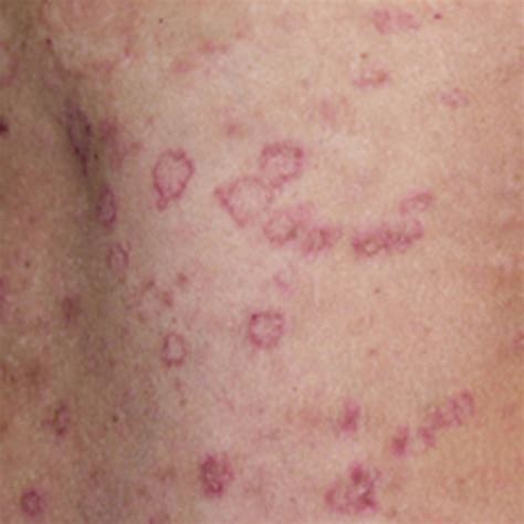Pityriasis Rosea Skin Disease Assumed May Caused Virus Which Cannot