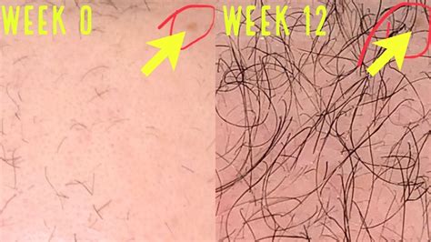 Multiple studies show and confirm that micro needling works in promoting hair growth in both men and women, and when used in conjunction with minoxidil 5%, many people will see far more superior results. UNBELIEVABLE MICRONEEDLING/DERMA ROLLING RESULTS FOR HAIR ...