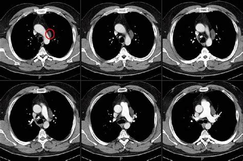 Pulmonary Roundtable Abnormal Ct Scan