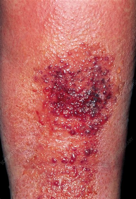 Cellulitis On A Womans Leg After An Insect Bite Stock Image M130