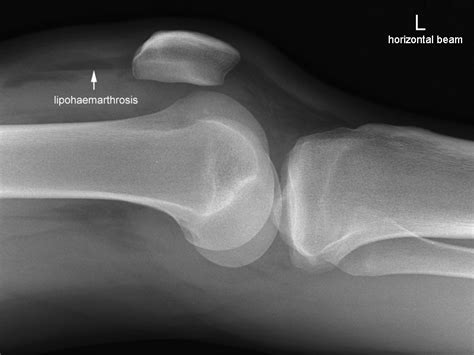Lateral Knee Radiography WikiRadiography