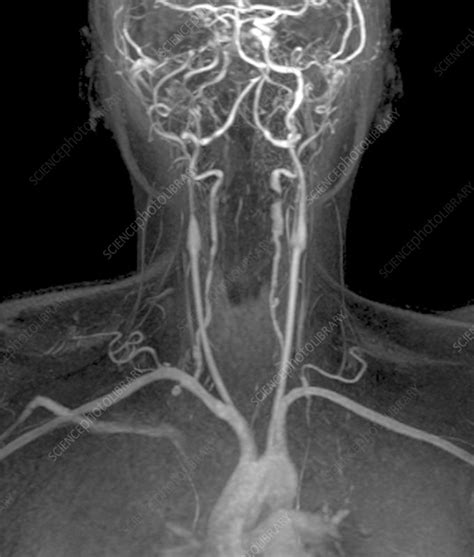 Stenoses In Neck Arteries Angio Mri Scan Stock Image C0041472