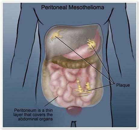 We did not find results for: mesothelioma new treatments #Mesothelioma | Mesothelioma ...