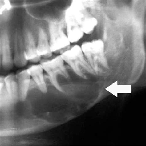 Primordial Cyst Panoramic Radiograph Shows A Welldefined Radiolucency