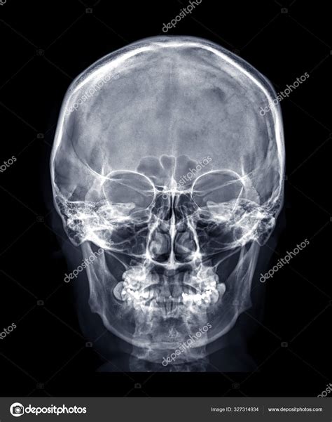 Skull Ray Image Human Skull View Front View Isolated Black Stock Photo