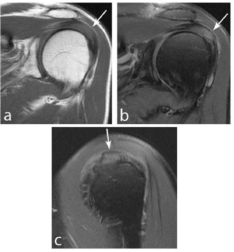 Figure 1 From Magnetic Resonance Imaging Of External Impingement Of The