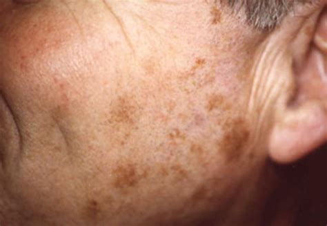 👉 Liver Spots Pictures Face Skin Hands Causes Treatment