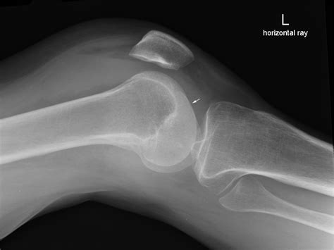 Lateral Knee Radiography Wikiradiography