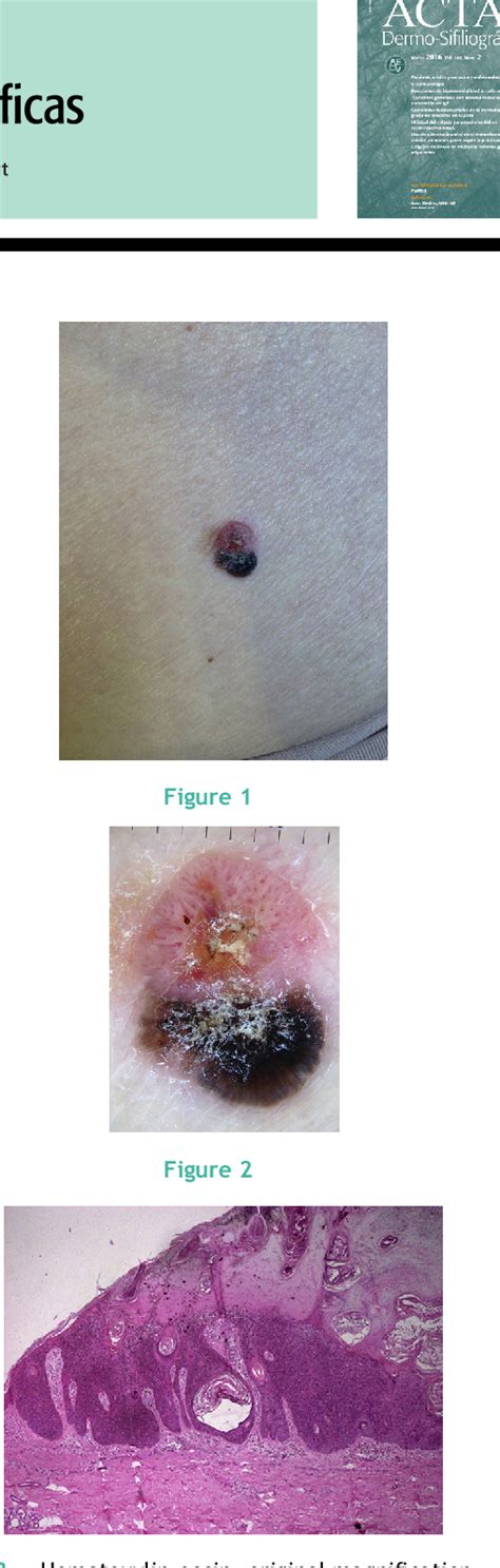 Figure 1 From Pigmented Vascular Tumor In Skin Not Exposed To Sunlight