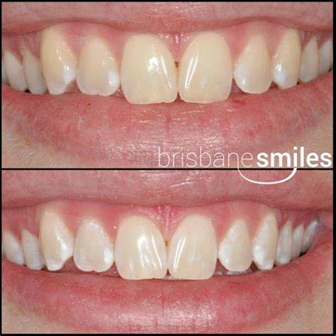 Teeth Whitening Photos Brisbane Smiles