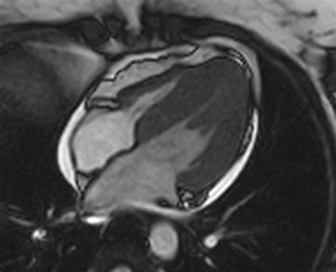 Myocarditides) is a general term referring to inflammation of the myocardium. Myocarditis MRI - wikidoc