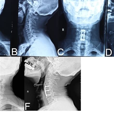 Pre And Post Operative Cervical X Rays Panels A And B Show Images Prior