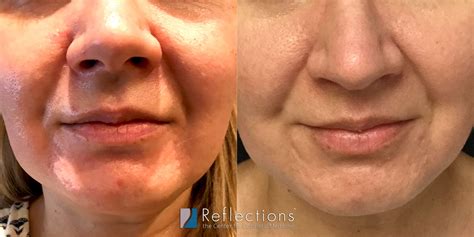 Hormonal Acne Laser Treatment Results For Nj Woman In Her 40s Before