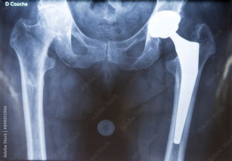 X Ray Of A Hip Prosthesis Stock Photo Adobe Stock
