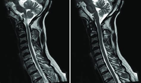 Sagittal Magnetic Resonance Imaging Sequences Of The Cervical Spine