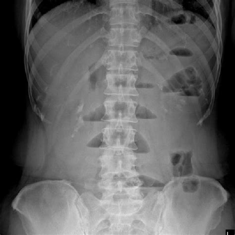 Upright Abdominal Radiograph Showing Multiple Air Fluid Levels
