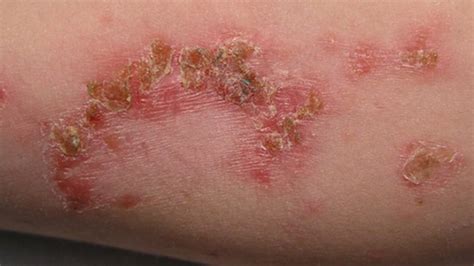 Purulent Skin Infections The Most Common Skin Diseases How To Fight Them Healthy Food Near Me