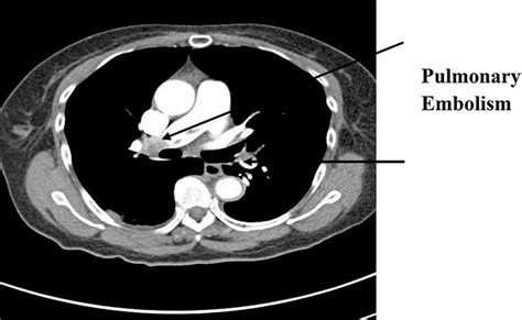 Ct Angiogram Showing Bilateral Pulmonary Emboli Download Scientific
