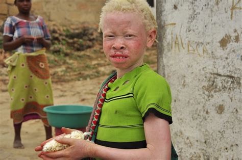 Albinos In Malawi Are Attacked And Killed For Body Parts