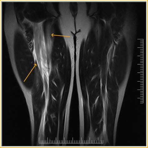 Biceps Femoris Tear Mri Sumer S Radiology Blog