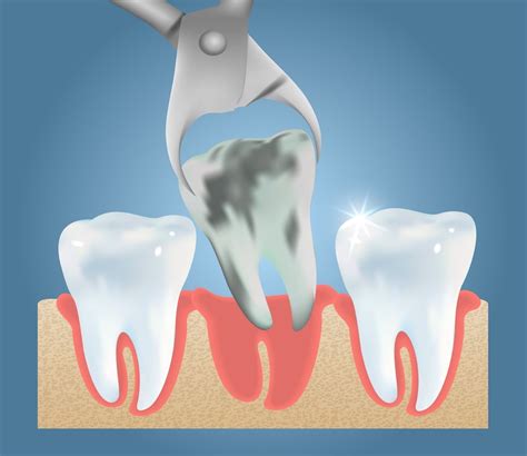 Tooth Extractions Process And Aftercare Broad Smiles Pediatric Dentistry