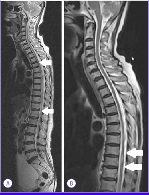 Whole Spine Mri T2 Weighted Sagittal Image On Admission A Shows