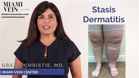 About Stasis Dermatitis Leg Discoloration Youtube