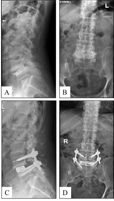 Preoperative Lateral A And Anteroposterior B Radiographs And