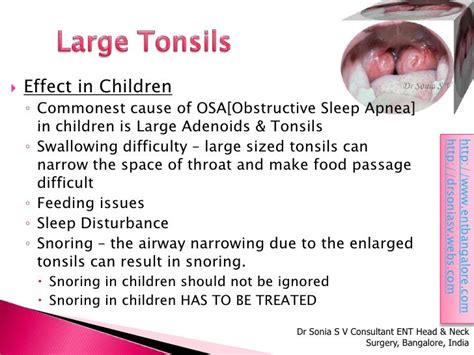 Tonsillitis Ent Doctor Bangalore