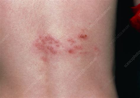 Rash Of Shingles Herpes Zoster On Lower Back Stock Image M260