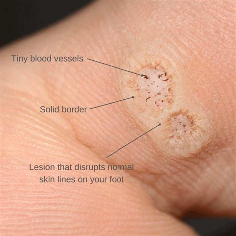 Plantar Warts Causes Symptoms And Treatment The Feet People Podiatry