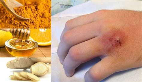 Home Remedies For Staph Infection Authority Remedies Home Remedies