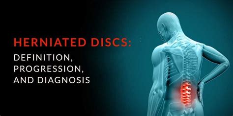 Herniated Disc Diagnosis