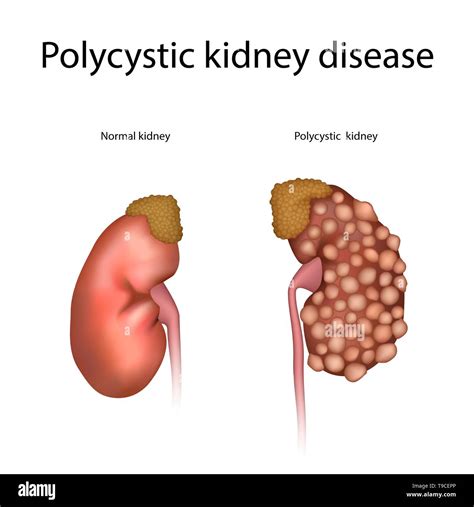 Polycystic Kidney Disease Illustration Stock Photo Alamy