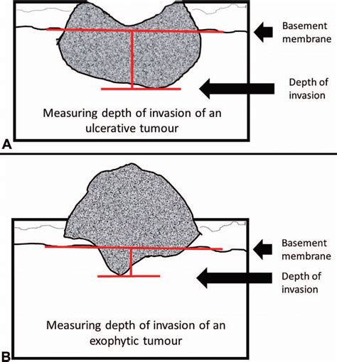 Measuring Depth Of Invasion Ulcerative A Versus Exophytic B Tumors