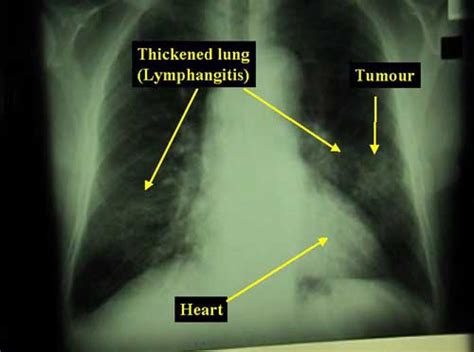 Lung Cancer Squamous Cell Carcinoma Of The Lung HealthEngine Blog