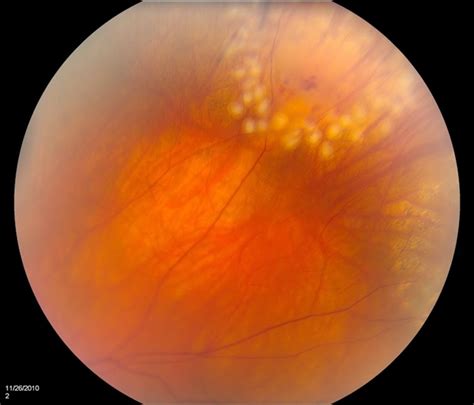 Lasered Retinal Tear Retina Image Bank