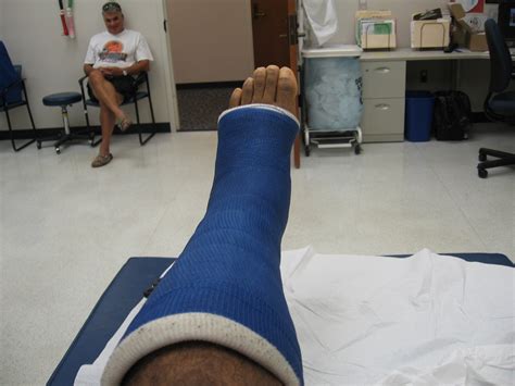 My Achilles Story 14 Days And One Cast Down