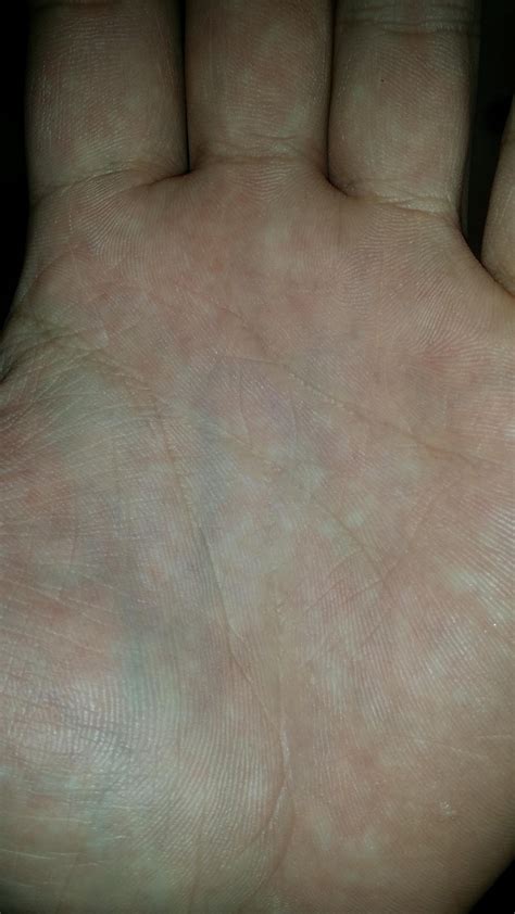 Veins In Palms Progressively Becoming More Visible Medical