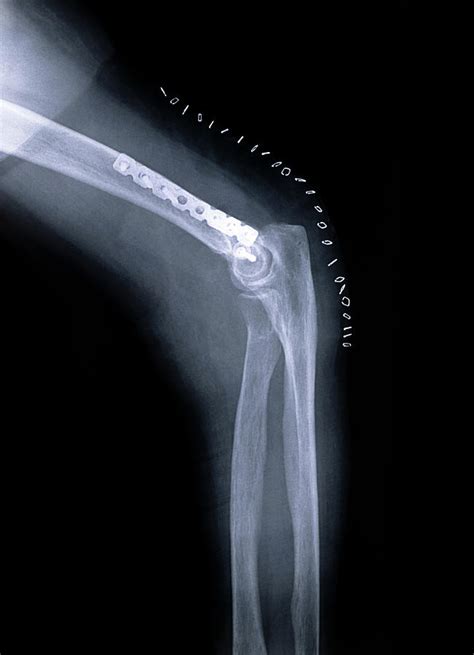 Pinned Elbow Fracture Photograph By Mauro Fermarielloscience Photo