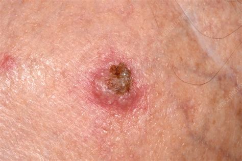 Squamous Cell Carcinoma Skin Cancer Stock Image C0370915 Science
