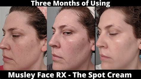Musely Face Rx Review The Spot Cream Youtube