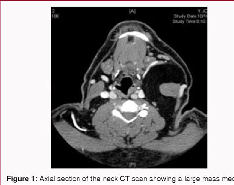 Figure 1 From Giant Deep Neck Lipoma A Case Report And Review Of The