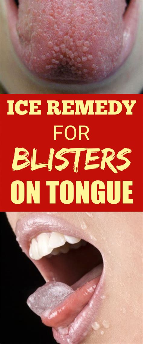 Blisters On Tongue Can Be Healed With These 7 Miraculous Home Remedies