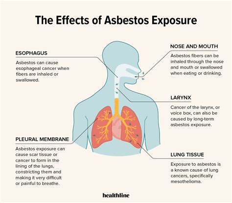 famous lung cancer asbestos exposure ideas