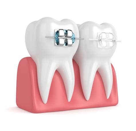 3d Render Of Teeth With Ceramic And Metal Braces University Dental
