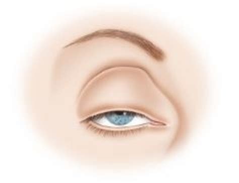 Droopy Eyelid Ptosis Treatment And Surgery Optegra