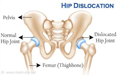 A dislocated hip can be very painful. Hip Dislocation | Dislocation of Hip - Causes, Symptoms ...